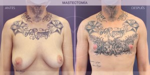Before and after image of a mastectomy procedure.
